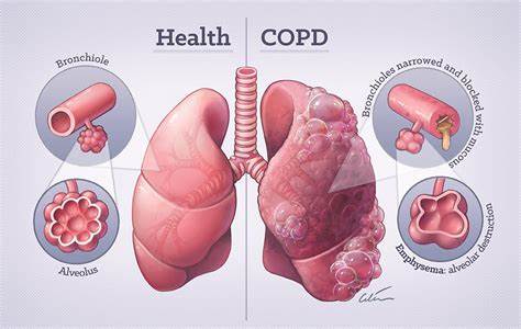 chronic obstructive pulmonary disease 