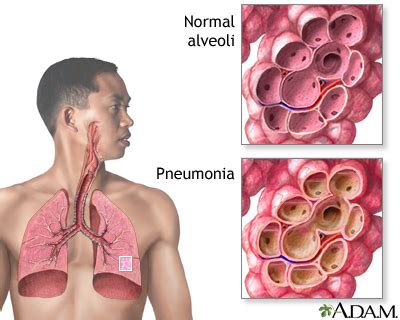 pneumonia