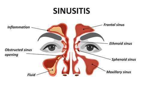 sinusits